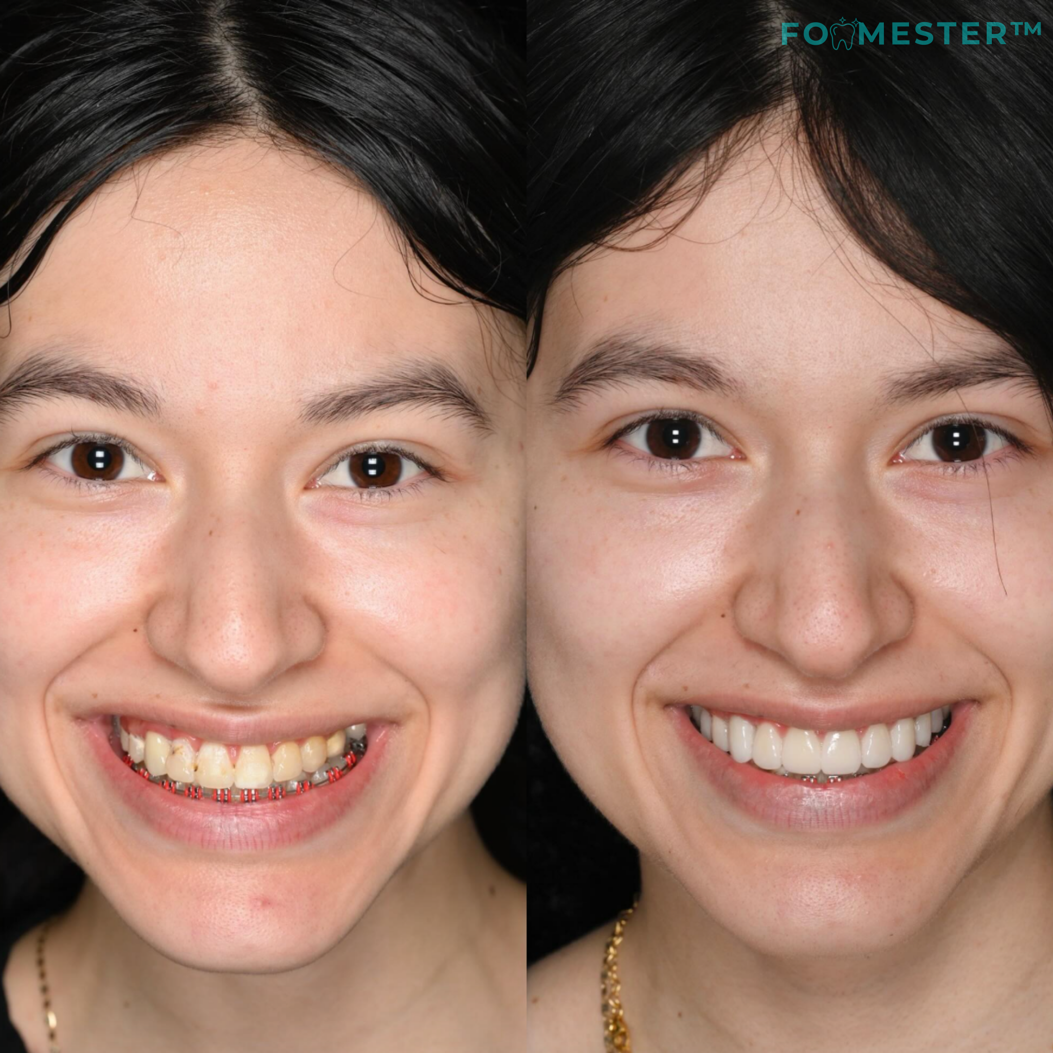 FogMester™ – automatikus fogmosás 30mp alatt